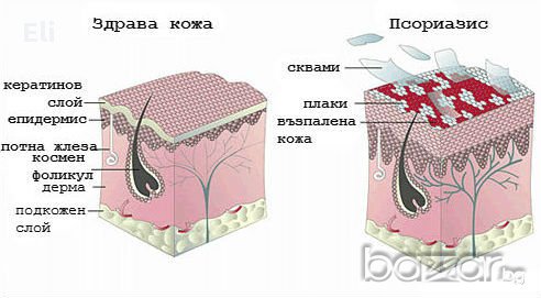 УНИКАЛЕН мехлем срещу псориазис, снимка 2 - Козметика за лице - 17003751