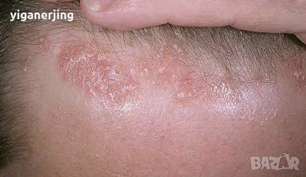 Натурален крем против себорея и зачервявания, снимка 4 - Козметика за тяло - 17843386