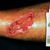 Спрей за рани, ухапвания, изгаряния, хрема - LR Emergency Spray Aloe Vera 150 ml (Код: 20600-150), снимка 6 - Други стоки за дома - 23827401