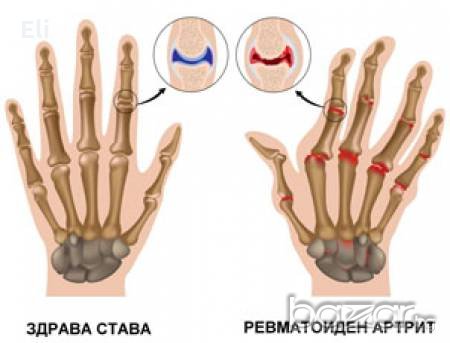 Експресен природен лек при ревматоиден артрит, снимка 2 - Козметика за тяло - 18822601