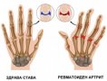 Експресен природен лек при ревматоиден артрит, снимка 2