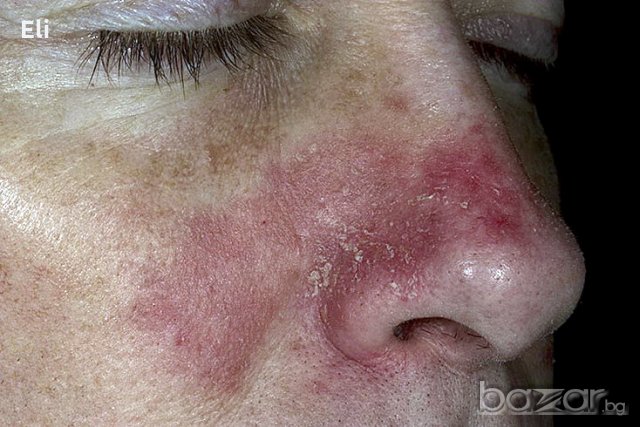 Натурален крем против себорея и зачервявания, снимка 3 - Козметика за тяло - 17843386