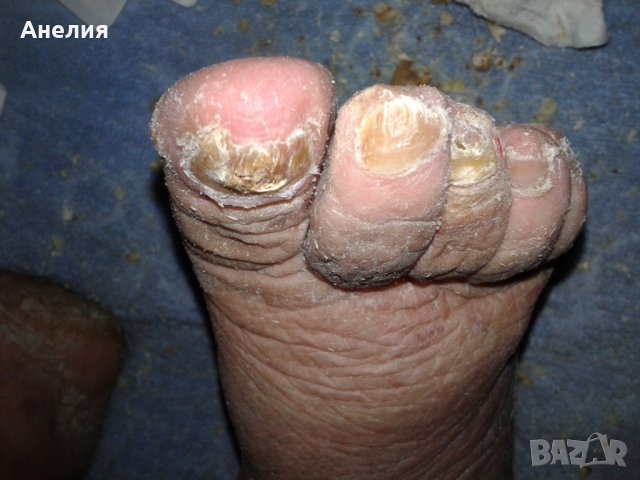 Медицински педикюр по домовете , снимка 6 - Медицински, стоматологични - 24454918