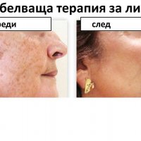 Избелваща терапия за лице - пилинг, маска, крем и лосион . Заличава белези, петна, лекета и акне, снимка 7 - Козметика за лице - 24361096