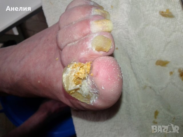 Медицински педикюр по домовете , снимка 13 - Медицински, стоматологични - 24454918