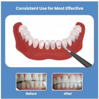 Ултразвуков уред за грижа за зъбите- за премахване на зъбен камък, снимка 5 - Стоматология - 39974065