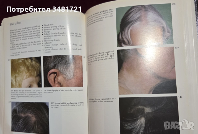 A Colour Atlas of the Hair, Scalp and Nails, снимка 9 - Специализирана литература - 52539726