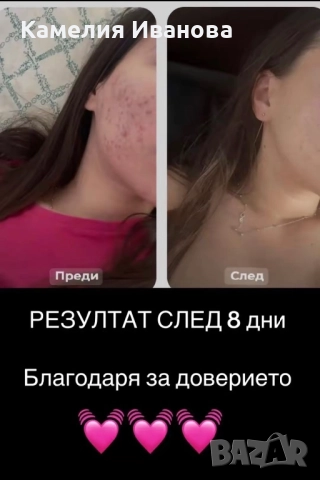 Силно избелващ крем Анти-Акне , снимка 4 - Козметика за лице - 52806065