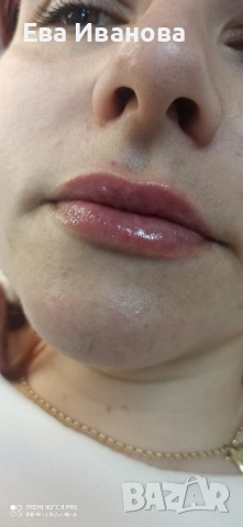 Безиглено уголемяване на устни с хиалурон , снимка 2 - Козметика за лице - 49811971