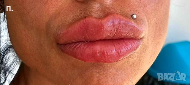 5мл. Филър за инжектор ПЕН, снимка 4 - Козметика за лице - 34778990