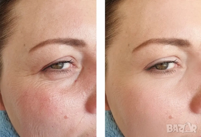 Ретинол Третиноин мелазмe хиперпигментация акне лице Acretin 0,025 0,05 , снимка 2 - Козметика за лице - 51942219