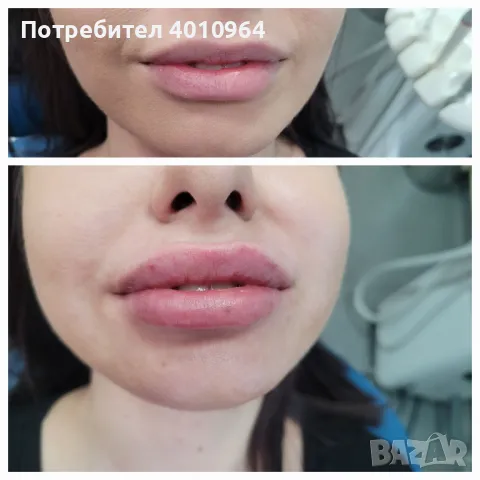 Дермални филъри, снимка 8 - Друго - 44934064