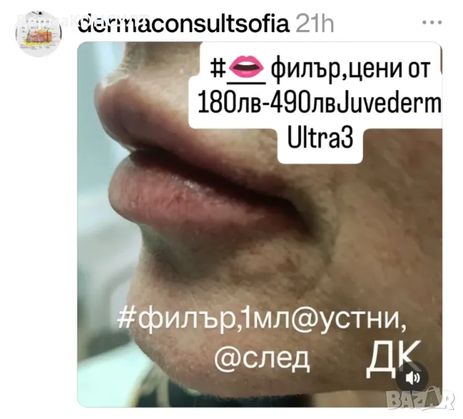 ДК,#филър хиалурон, устни, след, снимка 1