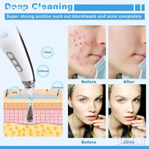 Vacuum blackhead remover премахване на черни точки, USB акумулаторен екстрактор на пъпки Tibobo, снимка 5 - Тримери - 48872982