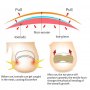Коригиращи Медицински Лепенки за Нокти Корекционни Деформирани Врастнали Нокът/ти Гъбички Паронихия, снимка 4
