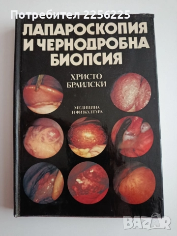 Лапароскопия и чернодробна биопсия