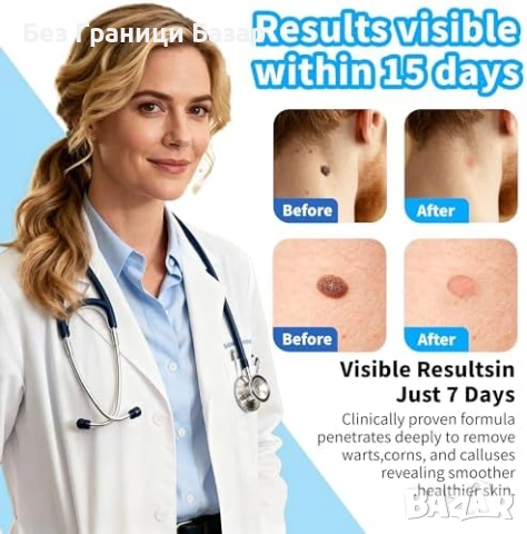 Нов Разтвор за брадавици кожни тагове мазоли калуси 30 мл бърз ефект, снимка 4 - Други - 53391118