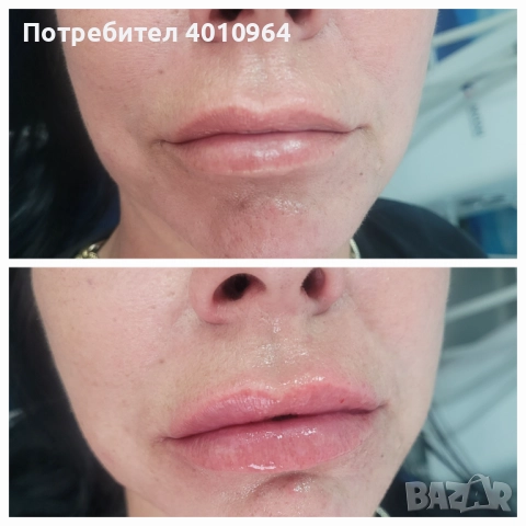  Дермални филъри, снимка 2 - Медицински, стоматологични - 52900689