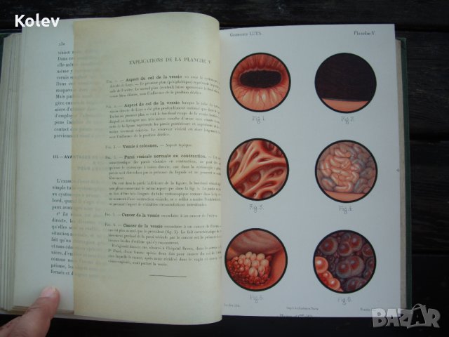 Медицинска книга Изследване на уринарната система, 1909 , френска, снимка 12 - Специализирана литература - 33406019