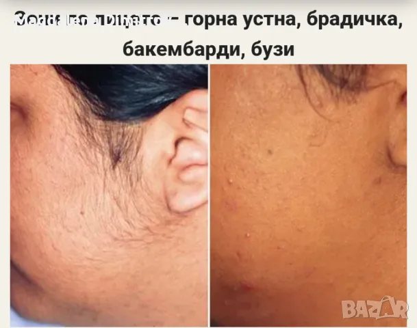 Лазерна епилация , снимка 5 - Друго - 49438284