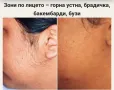 Лазерна епилация , снимка 5