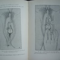 Медицинска книга Изследване на уринарната система, 1909 , френска, снимка 15 - Специализирана литература - 33406019