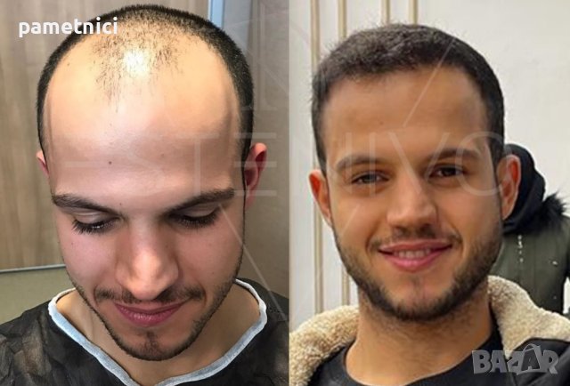 Присаждане на Коса Промоционална цена!, снимка 18 - Медицински, стоматологични - 26976880