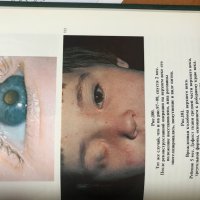 Глазные болезни - aтлас, снимка 6 - Специализирана литература - 28598504