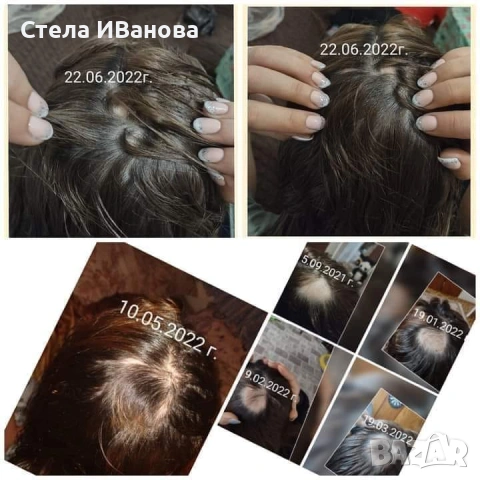 Комплект за бърз растеж на косата, при косопад, оплешивяване, алопеция