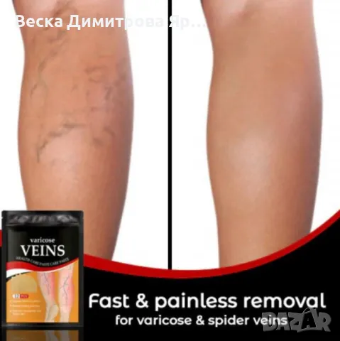 Здравен пластир за лечение на разширени вени Varicose Care Health Patch 12бр, снимка 4 - Други - 49435127