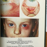 Глазные болезни - aтлас, снимка 7 - Специализирана литература - 28598504