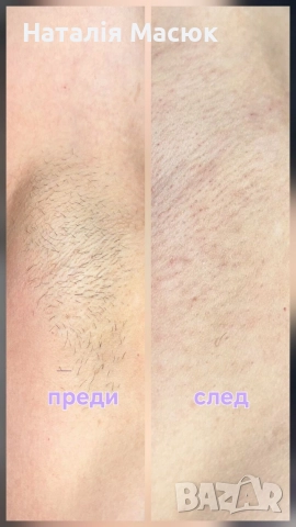 Електроепилация в Пловдив – Премахване на косми завинаги., снимка 4 - Друго - 52709676