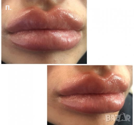 5мл. Филър за инжектор ПЕН, снимка 2 - Козметика за лице - 34778990