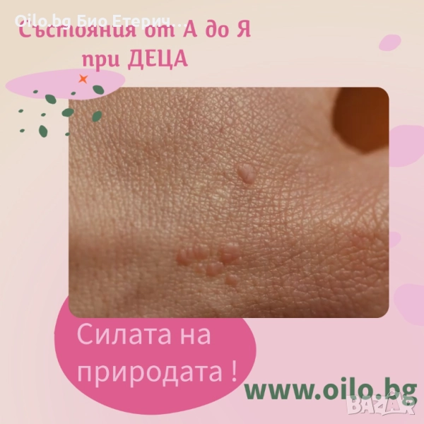 Брадавици при деца? Решението е в природата!, снимка 1