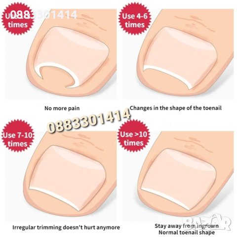 Уред за врастнали нокти , снимка 7 - Други - 43031534