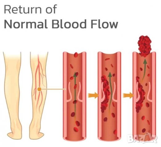 Стикери Против Подуване на Вените Облекчават Краката Болка Бедро Метаболизъм Васкулит Кръвообращение, снимка 3 - Други - 38073595