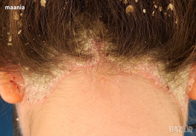 ПСОРИАЗИС, СЕБОРЕЯ, ПЪРХОТ, гъбички, ранички и екзема по главата, снимка 1